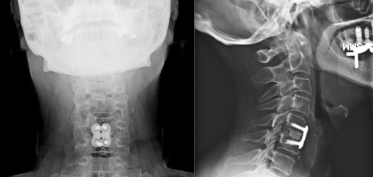 img-anterior-cervical-discectomy-and-fusion-01