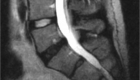 Degenerative disc disease (DDD) Degenerative disc disease (DDD)