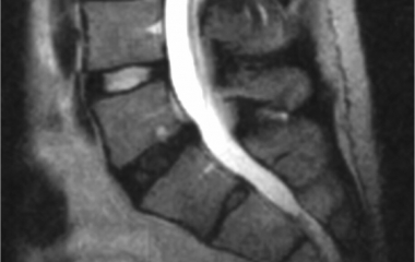 Degenerative disc disease (DDD)