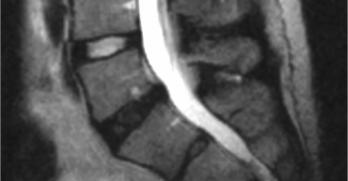 Degenerative disc disease (DDD) Degenerative disc disease (DDD)