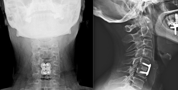 ACDF – Anterior Cervical Discectomy and Fusion ACDF – Anterior Cervical Discectomy and Fusion