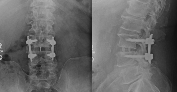 Lateral Lumbar Interbody Fusion (LLIF) Lateral Lumbar Interbody Fusion (LLIF)