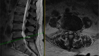 Lumbar laminectomy Lumbar laminectomy