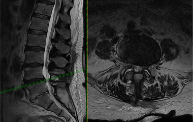 Lumbar laminectomy