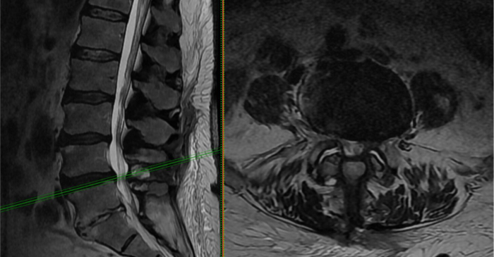 Lumbar laminectomy Lumbar laminectomy