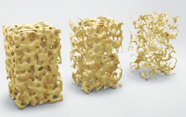 Osteoporosis and spine health