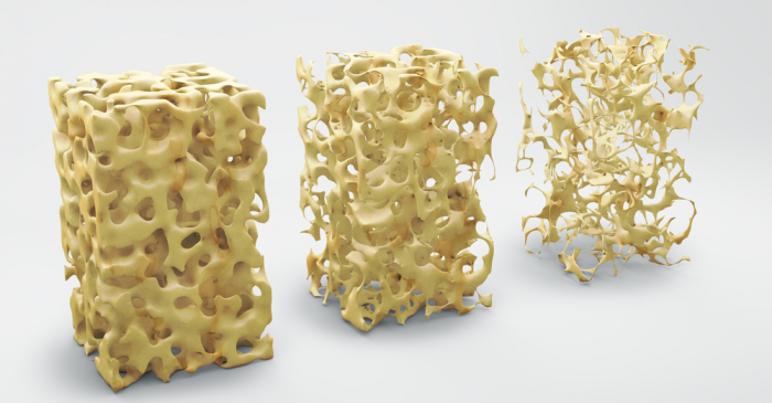 Osteoporosis and spine health Osteoporosis and spine health