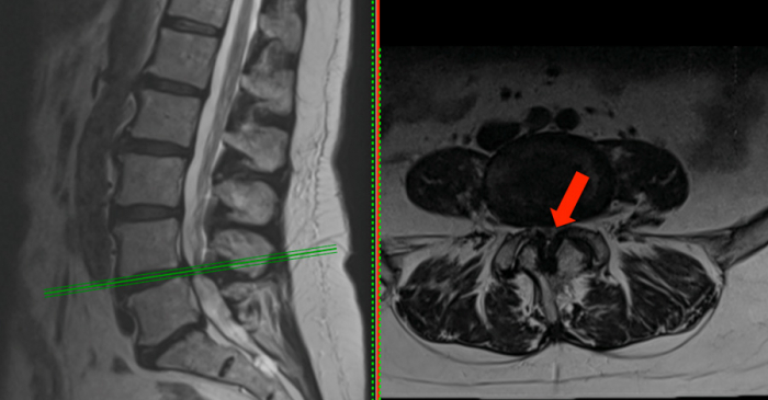 Spinal stenosis and neurogenic claudication Spinal stenosis and neurogenic claudication
