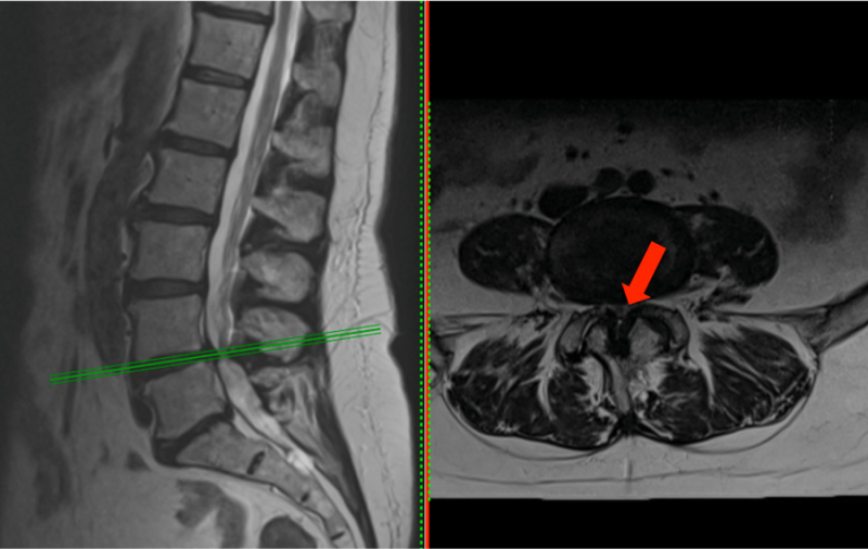 Spinal stenosis, Radiology Reference Article