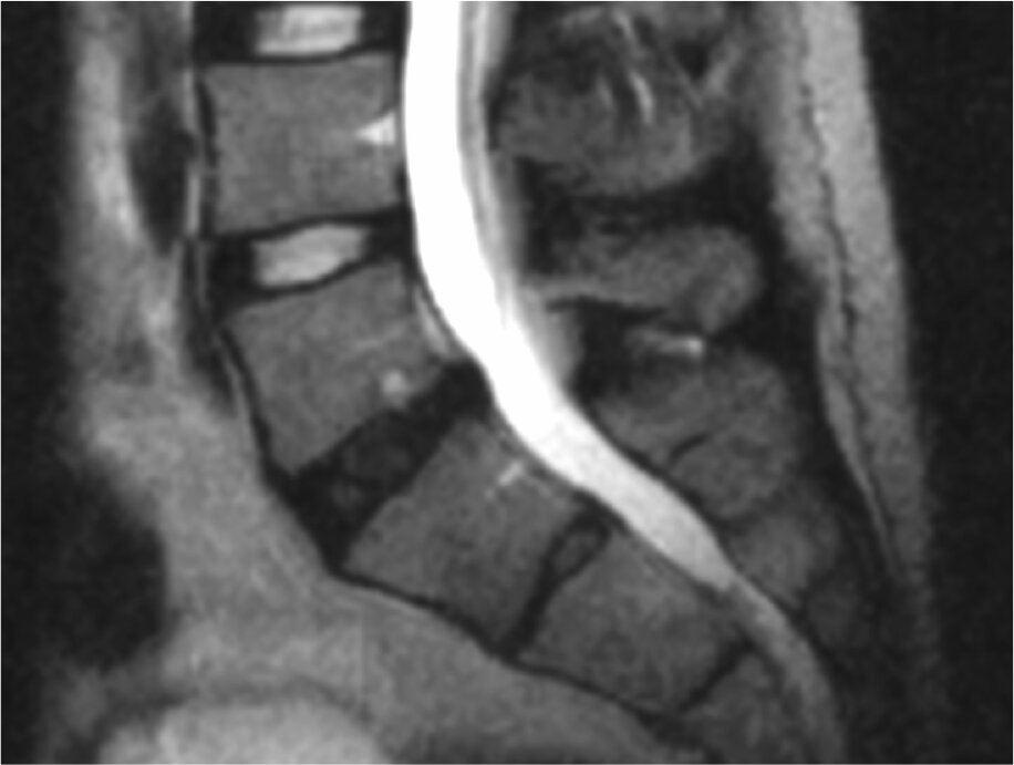 degenerative-disc-disease-1