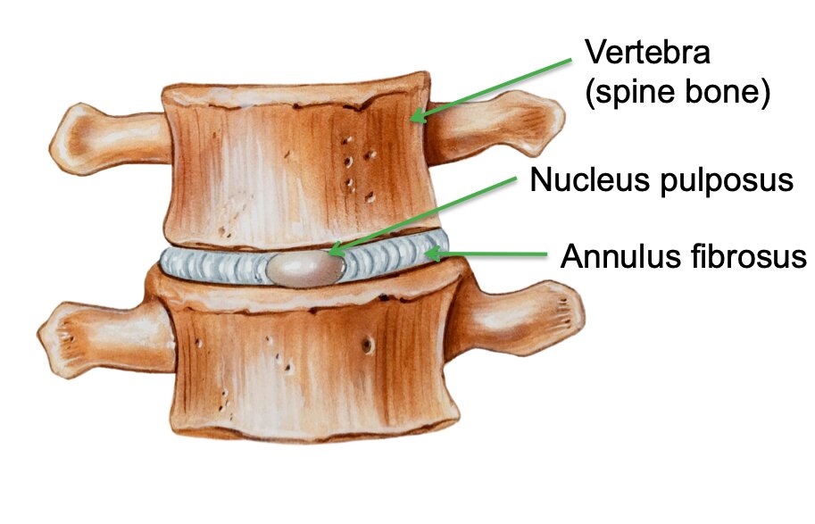 degenerative-disc-disease-2