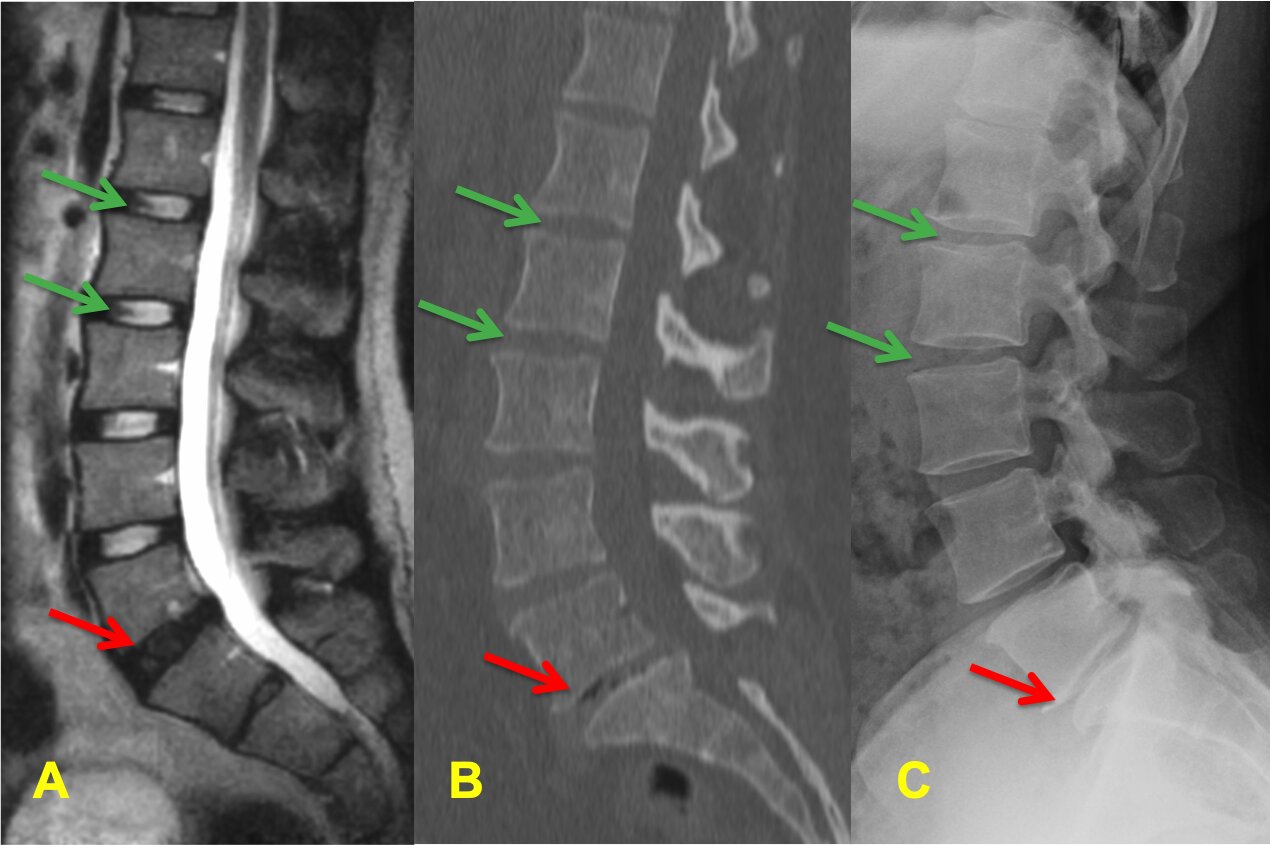 degenerative-disc-disease-3