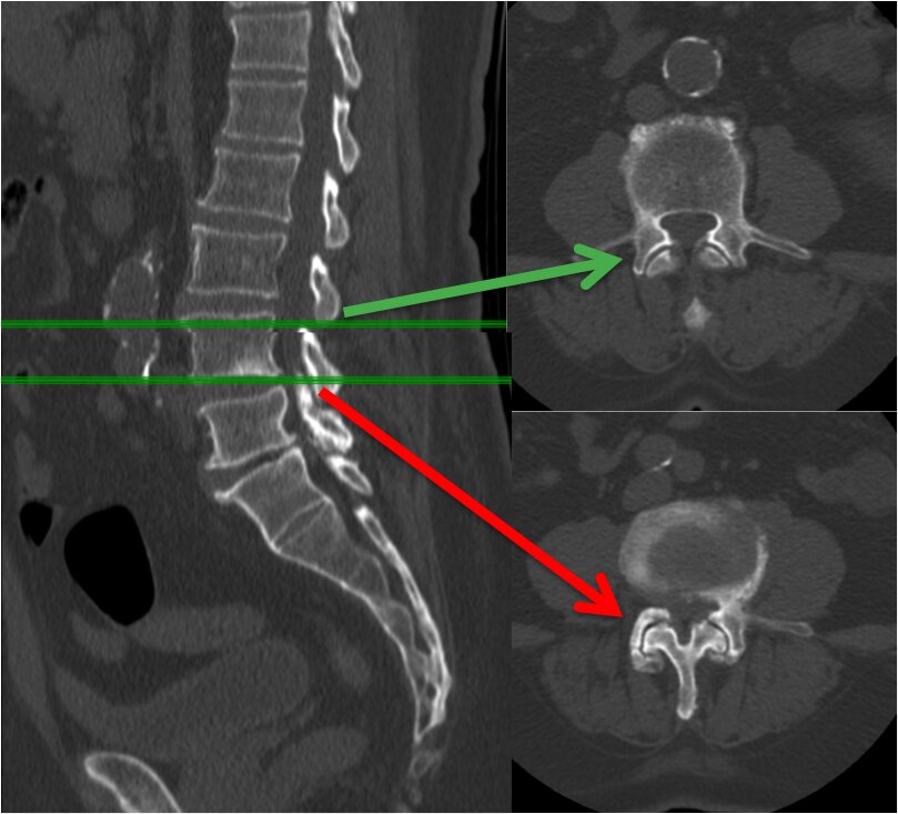 degenerative-disc-disease-4