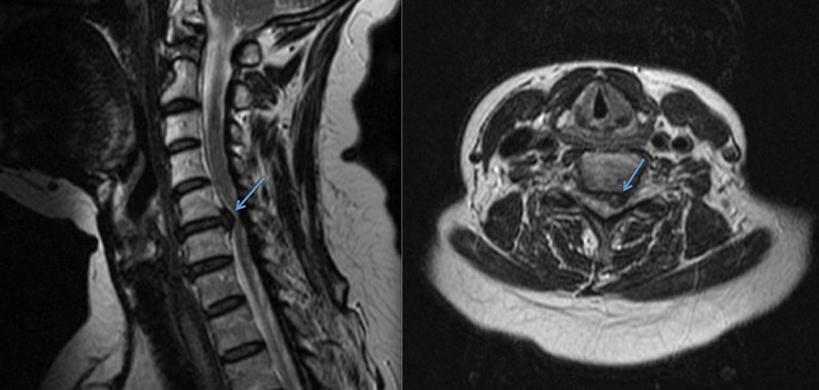 img-anterior-cervical-discectomy-and-fusion-02