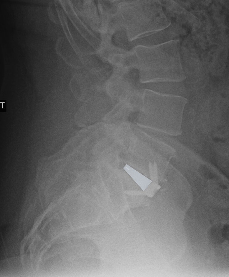 img-anterior-lumbar-interbody-fusion-2