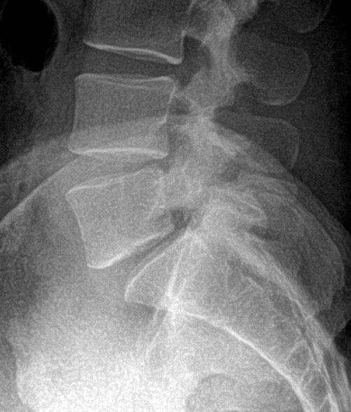 img-anterior-lumbar-interbody-fusion-3