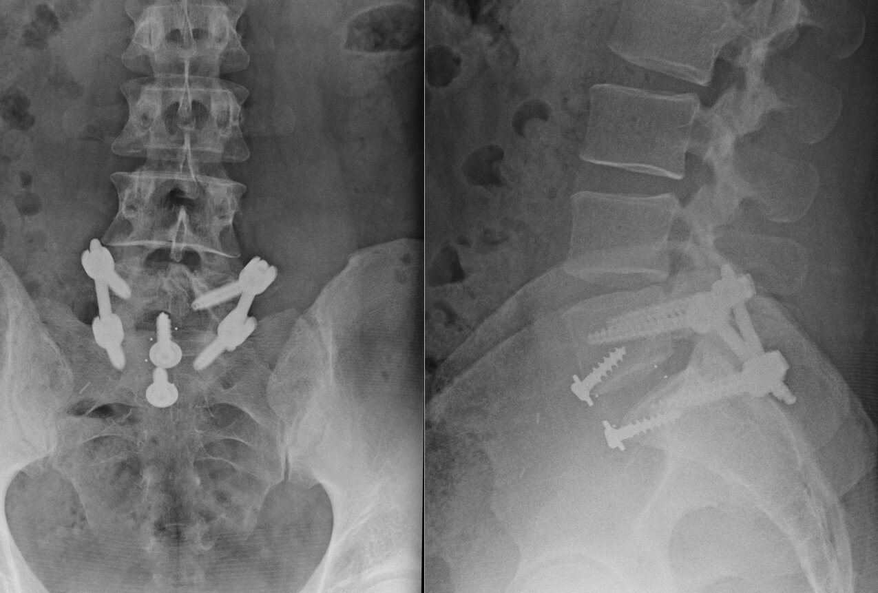 img-anterior-lumbar-interbody-fusion-4