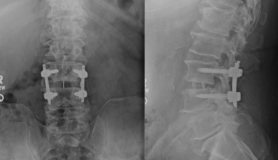 img-lateral-lumbar-interbody-fusion-01