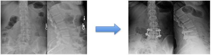 img-lateral-lumbar-interbody-fusion-02