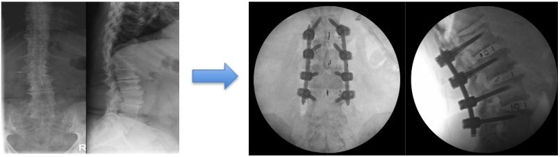 img-lateral-lumbar-interbody-fusion-03