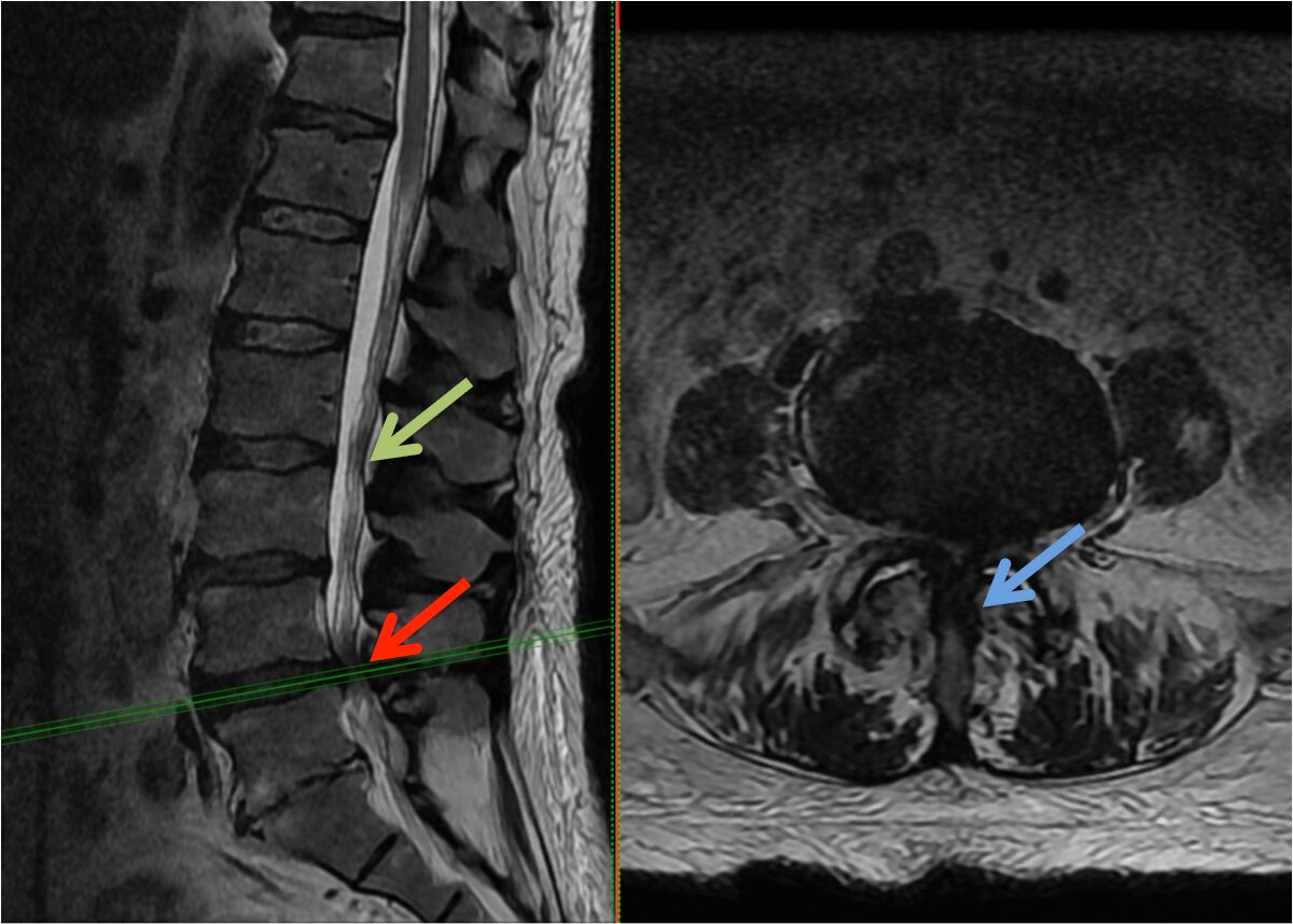 img-lumbar-laminectomy-2