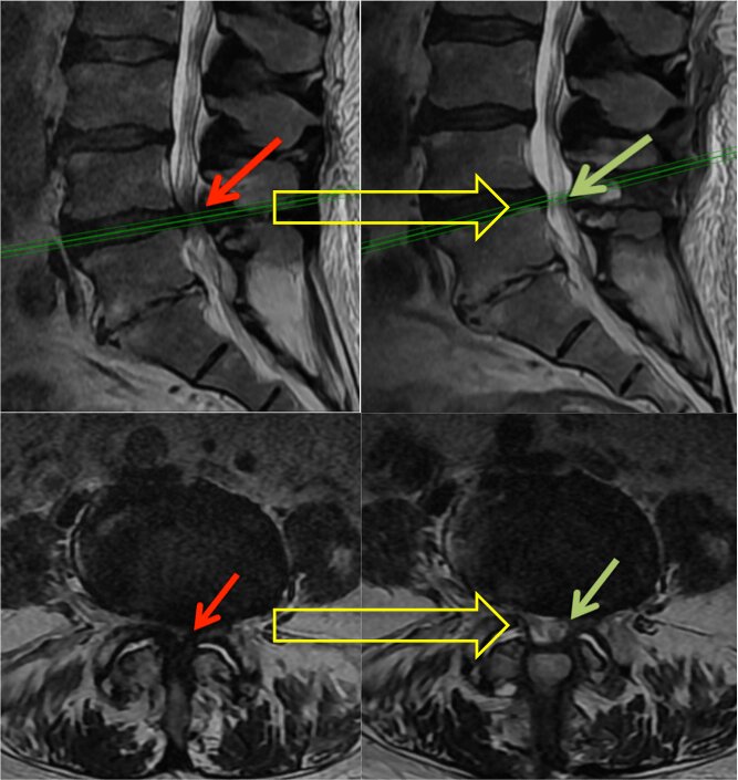 img-lumbar-laminectomy-3