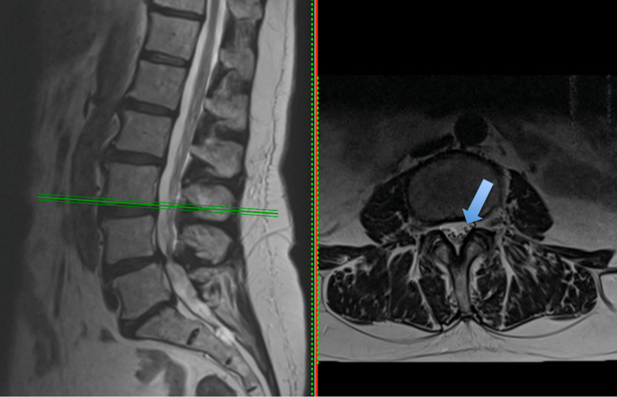 Spinal stenosis and neurogenic claudication - Lubbock, Amarillo