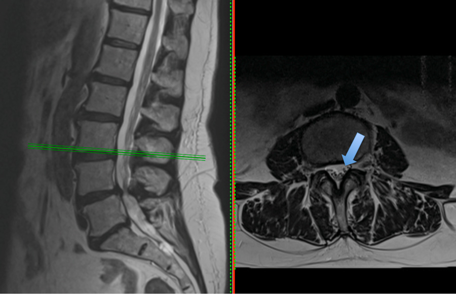 img-spinal- stenosis-neurogenic-claudication-1