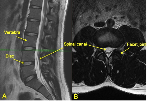 spinal-decompression-1