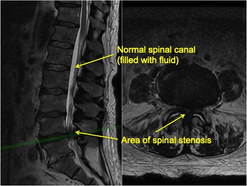 spinal-decompression-2