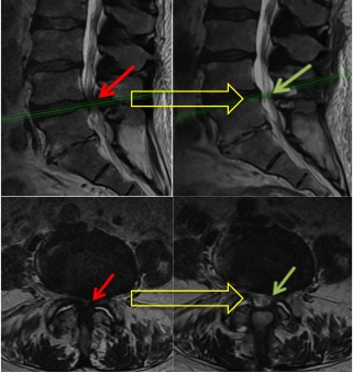 spinal-decompression-3