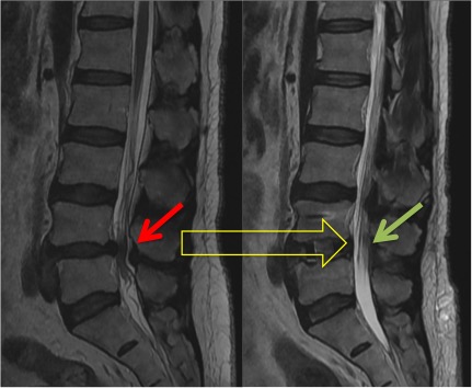 spinal-decompression-7